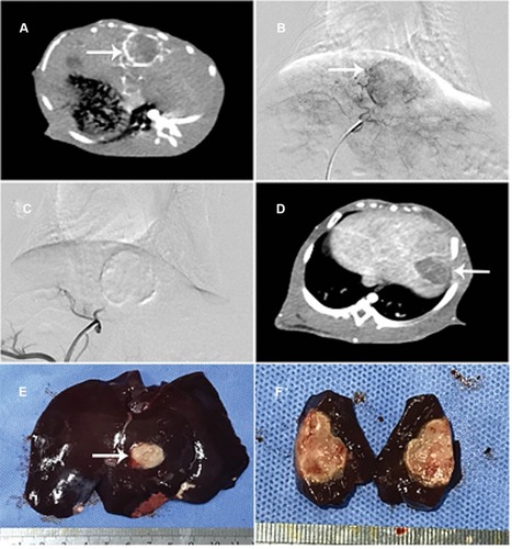 Figure 1 Construction of animal model and transarterial embolization. All 64 rabbits were incubated with VX2 tumor successfully at 16 days post implantation (A, B). Transarterial embolization in the CSM-ATO group was exemplified as follows: the blood supply was embolized completely after transarterial embolization (C); at 7-days post treatment, tumor volume of rabbits was not increased (D), then the tumor tissue sample was obtained and dissected (E), showing that the tumor was necrotic throughout (F).