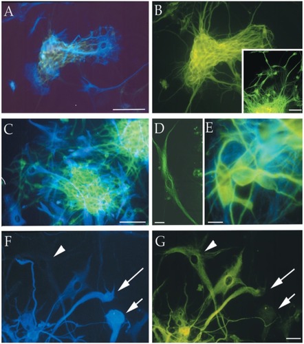 Figure 4 Immunofluorescence photomicrographs of representative MC-PL clones derived from different cortical glial tumor specimens (T1–T3, T6, and T7) processed for double (A, B, C, E, F) or single (B inset, D) labeling for different neural markers. The cells positive for the neuronal marker β-III tubulin are stained green (FITC), and the cells that expressed the astroglial marker GFAP are stained blue (AMCA). The arrowhead in F points out a cell that is not labeled for GFAP, but is immunopositive for β-III tubulin (arrowhead in G). The short arrow in F points out a cell that is immunolabeled for GFAP, but immunonegative for β-III tubulin (short arrow in G). The long arrow in F and G points out a cell that is labeled with both immunomarkers. Scale bars are 10 μm (F and G) and 100 μm (A–E). Copyright © 2002. CitationIgnatova T, Kukekov V, Laywell E, et al. 2002. Human cortical glial tumors contain neural stem-like cells expressing astroglial and neuronal markers in vitro. Glia, 39:193–206.