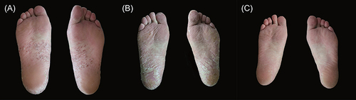 Figure 1 Paradoxical palmoplantar pustulosis lesions on patient’s soles (A), after 3 months treatment with secukinumab (B) and 10 months treatment with ixekizumab (C).