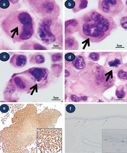 Figure 2. Light microscopic findings of various morphologically atypical cells in Beas-2B cell line. (a) atypical cell with double nuclei (b) atypical cell with multilobulated nuclei (c) atypical cell with hyperchromatic obscured nuclei, (d) multilobulated cell and mitotic figure (arrow) (a-d) (e) all cultured cells show strong positivity for Ki-67 (F) Ki-67 staining of normal human bronchial epithelial tissue; 1‒3 positive cells/100 bronchial epithelial cells.