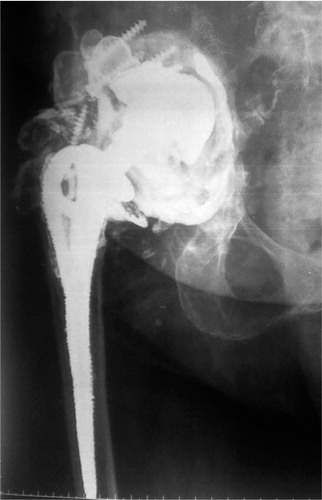 Figure 1. Pre-revision radiograph. An unexplained “hallo formation” can be seen surrounding the acetabular components.