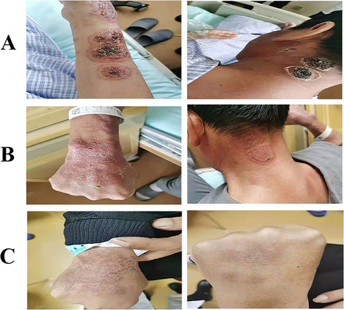 Figure 4 Photographs showing clinical remission of skin lesions after administration of IFX. (A) Skin lesions observed after the first cycle of IFX treatment. (B) Lesions observed before administration of the second cycle and, (C) Before administration of the third cycle of IFX therapy.