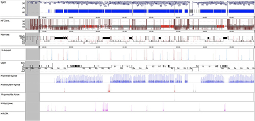 Figure 4 The titration sleep study report of patient 1 in the TECSA group.