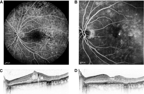 Figure 2 A 62-year-old patient with cystoid macular edema in the left eye previously treated with three monthly injections of intravitreal bevacizumab.