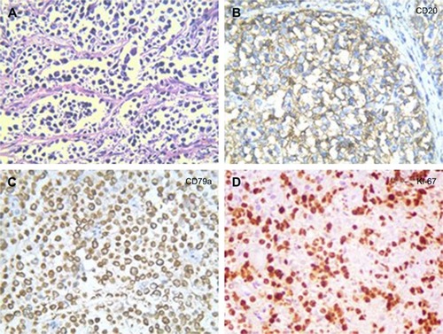 Figure 3 Histopathology showed small tumor cells without cell adhesion or tissue structure proliferation (A), and HE immunochemical staining was positive for B-cell markers CD20 and CD79a (B, C), compatible with the diagnosis of diffuse large B-cell non-Hodgkin lymphoma. HE immunochemical staining confirmed a proliferative index of over 50–60% (D). (A–C ×400; D ×200).