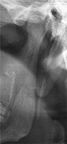 Figure 4 Type III – segmented styloid process.