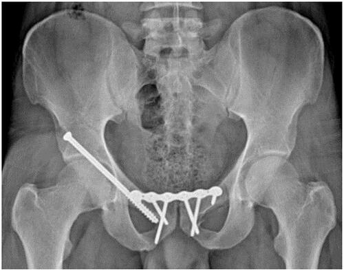 Figure 4 Anteroposterior x-ray image of the pelvis at 6 months follow up.