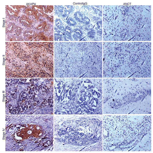 Figure 3. AKAP4 expression in representative Stage I, Stage II, Stage III and Stage IV tissue ovarian cancer specimens. Serial sections from ovarian cancer samples representative of all FIGO stages (left and middle panels) or from matched adjacent non-cancerous tissue (ANCT) specimens (right panel) were probed with polyclonal anti-AKAP4 antibodies (left and right panels) or with non-specific IgGs (central panel), as a staining control condition.