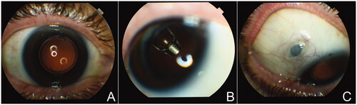 Figure 2. Clinical images from PDS-implanted patients. (A) In the primary position, the PDS implant is not visible through the dilated pupil. (B) In superotemporal gaze, the lower portion of the body of the implant and the release control element are visible through the dilated pupil. (C) When eye looking inferonasally, the septum of the implant is visible through the conjunctiva. Images courtesy of Dr. Arshad Khanani, Sierra Eye Associates, Reno, NV, USA.