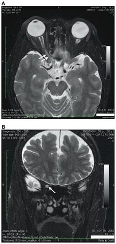 Figure 1 Orbital MRI T2-weighted sequences demonstrating hyperintensity in the posterior aspect of the right optic nerve (arrows). Hyperintensity is seen in both axial (A) and coronal (B) images.