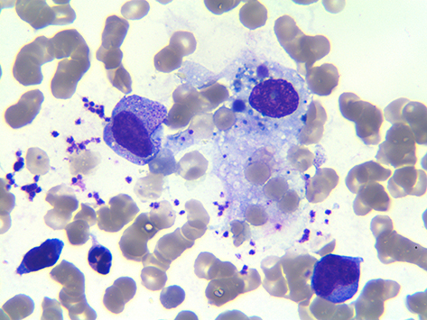 Figure 1 Bone marrow aspirate showing hemophagocytosis (Wright-Giemsa staining, ×1000).
