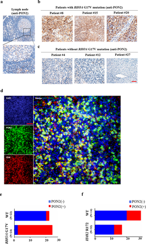 Figure 5. PON2 expression is associated with RHOA G17V mutation in AITLs. (a–c) Immunohistochemical analysis of PON2 distribution in normal human lymph nodes (a) and lymphoma biopsies isolated from patients with AITLs bearing RHOA G17V mutation (b) or without RHOA G17V mutation (c). EliVision Plus two-step immunohistochemical technique with 3–3’ diaminobenzidine (DAB) staining was used. Original magnification: × 400. scale bar: 10 µm. (d) Detection of PON2 in AITL cells by Multiplexed fluorescence immunohistochemistry. Left upper panel shows conventional DAPI staining. Left middle panel shows the single PON2 staining in green. Left lower panel shows the single CD4 staining in red. Right panel shows the multiplexed fluorescence staining of PON2 and CD4. Original magnification: × 200; scale bar: 100 µm. (e) The histogram illustrates the percentage of PON2 immunostaining in AITLs bearing RHOA G17V mutation or without RHOA G17V mutation. AITLs with RHOA G17V mutation showed significantly higher PON2 expression levels than AITLs with RHOA wild-type (WT) (chi-square test, P = .002). (f) The histogram illustrates the percentage of PON2 immunostaining in AITLs bearing IDH2 R172 mutation or without IDH2 R172 mutation. There was no difference in PON2 immunostaining between AITLs with IDH2 R172 mutation or without IDH2 R172 mutation (chi-square test, P = .908).