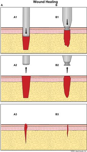 Figure 4 The wound-healing advantage of the flared all-purpose punch. (A) A1–A2: outer beveled punch cutting axis, directed downwards and inwards, cuts a cylindrical wound column with a relatively everted papillary dermal edge; A3: most of the wound closes primarily due to wound contraction. The top papillary portion remains patent, relying more on second intention healing for wound closure and resulting in a larger scar; (B) B1–B2: The flared punch cutting axis, directed outwards to bite into the tissue lateral to the punch. The first cut into the papillary dermis cuts a wound path that is relatively inverted compared to that of non-flared punches, resulting in a cylindrical wound column with a relatively inverted papillary dermal edge; B3: most of the wound closes primarily due to wound contraction, including the majority of the wound’s top papillary portion, bringing the edges closer together, such that the entire top part either closes by primary intention or recruits a relatively smaller degree of second intention, healing with less scarring.