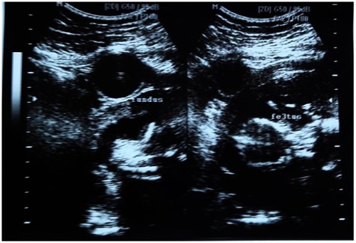 Figure 2 Transvaginal sonography findings show the balloon catheter was as high as the maternal umbilicus.