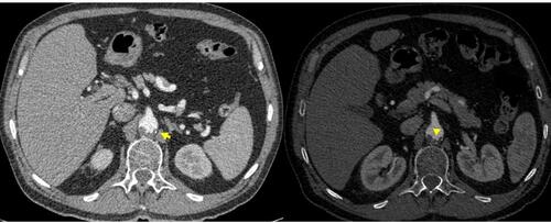Figure 4 Two computed tomography slices showing a mural thrombus. As a difference to aortic intramural hematoma, intimal calcium remains external to the thrombus (arrow). Borders are usually irregular (arrowhead).