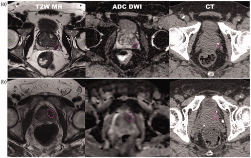 Figure 1. Intraprostatic lesions delineated on T2-weighted MRI and apparent diffusion coefficient (ADC) maps and transferred to CT for planning, for (a) patient 7 and (b) patient 3.