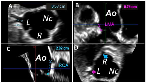 Figure 2. (A) The axial view shows the origin of the left coronary artery; the dotted line indicates the length of the left coronary artery to its bifurcation. (B) Coronal view shows the origin and the height take-off of the left coronary artery (dotted line). (C) Sagittal view shows the origin and the height take-off of the right coronary artery (dotted line). (D) Origin and deployment of the right (arrow) and left coronary arteries (asterisk). Abbreviations: Ao: aorta; L: left sinus of Valsalva; LMA: left main artery; Nc: non-coronary sinus of Valsalva; R: right sinus of Valsalva; RCA: right coronary artery (from reference [Citation8]).