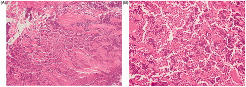 Figure 2. Sternal biopsy. HE stain (4× magnification) shows tumour cell infiltration between muscle fibres (A). HE stain (40× magnification) shows a high-grade population of ‘small blue round cells’, compatible with Ewing’s sarcoma (B).