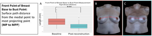 Figure 13. The front point of breast base to bust point measurement (medial point to most projecting point) for the participants who underwent bilateral implant-based reconstruction significantly decreased after implant-based reconstruction (right breast: p < 0.001, left breast: p < 0.001). (A) Boxplot (median and interquartile range) of the front point of breast base to bust point measurement at baseline and post-reconstruction for the right breast (left was similar). (B) The front point of breast base to bust point measurement on an exemplar patient at baseline. (C) The front point of breast base to bust point measurement on the same patient post-reconstruction.