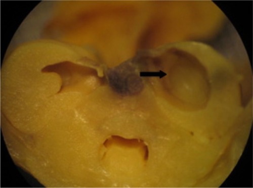 Figure 5 Visceral alteration in the fetus from a rat treated with vehicle.Notes: Dilated renal pelvis (arrow). Vehicle = 20 nM 4-(2-hydroxyethyl)-1-pipera-zineethanesulfonic acid (HEPES) buffer containing 1% sodium citrate.