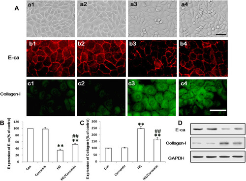 Figure 2 Effects of Curcumin on EMT markers collagen I and E-ca in NRK-52E cells. (A) Effects of Curcumin on morphological changes in NRK-52E cells (a1–a4) and HG treatment in the cells for 48 h led to cell morphological change to a fibroblast-like shape (a3). Protein expression EMT markers, including E-cadherin (red, b1–b4) and collagen I (green, c1–c4), in NRK-52E cells were detected with immunofluorescence chemistry (above, a1-c1. Control group; a2-c2. Curcumin group; a3-c3. HG group; a4-c4.HG plus Curcumin group. Magnification was ×400, Scale bars=30 μm) and Western blot ((B–D), below), and represented in control group; curcumin group; HG group and HG plus Curcumin group, respectively (**P < 0.001 vs Control group, ##P < 0.001 vs HG).