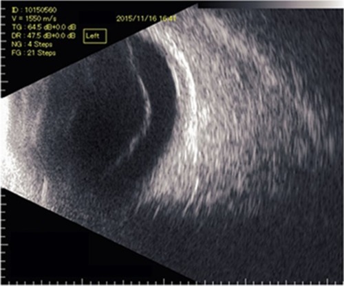 Figure 2 B-scan ultrasonography of the left eye.