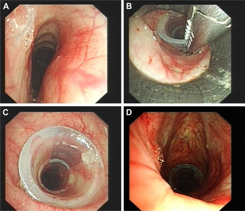 Figure 3 Bronchoscopic examination through the nose (A) showed that the trachea was depressed. (B) Silicone tracheobronchial stent of diameter 16×14×16 mm and length 15×20×15 mm was placed with the help of the bronchoscope. (C) Tracheobronchial stent placed on stenosed trachea site. (D) Final image after placement of the tracheobronchial stent.