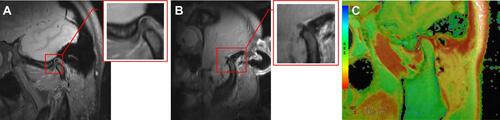 Figure 3 Normal temporomandibular joint in adolescents: closed-mouth position (A), open-mouth position (B), and T2 mapping image artifact (C).