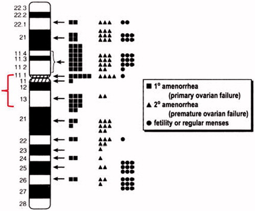Figure 1. Schematic diagram of the X chromosome showing ovarian function as a function of non-mosaic terminal deletions. There are a large number of phenotypic conditions that have been associated with the deleted/duplicated/inactivate or mutated regions on the X chromosome. The terminal X chromosome deletions are often associated with functional ovarian phenotypes and proximal Xq (such as Xq13) deletions often result in absent breast development, primary amenorrhea, and gonadal failure. Therefore, the non-classical form of Turner syndrome, which is called variant Turner syndrome, shows a highly variable phenotype due to the genotypic background of the patients. (a): the region of the marker chromosome [Simpson and Rajkovic Citation1999]. The schematic demonstration of the marker chromosome gene continent, which contained the Xq11.2q13.2 region with the androgen receptor and the X-inactive specific transcript genes and with a deletion of the region distal to Xq13.2.