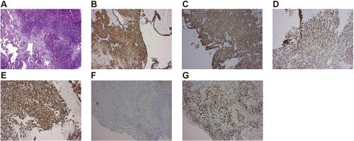 Figure 3 Pathological features of the carcinoma of upper ureter: (A) H&E showing urothelial squamous metaplasia; (B) positive immunostaining in tumor cells with CK5/6; (C) intense positive immunostaining for CK-HMW (+) in tumor cells; (D) positive immunostaining in tumor cells with CK8/18 (+++); (E) positive immunostaining in tumor cells with CK7 (+); (F) positive immunostaining in tumor cells with Vim (focal +); (G) tumor cell proliferation rate as determined by Ki-67 immunostaining showed 60% of positive cells.