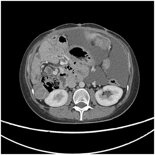 Figure 5. CT slice in patient whose CT peritoneal cancer index (PCI) was 24.