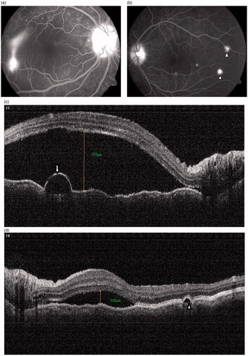 FIGURE 2. (a) Typical smokestack leak (arrow) with optic disc staining and multiple pinpoint leaks were seen at the posterior pole in the right eye. (b) Two small PED leaks (arrowheads) with disc staining and multiple pinpoint leaks are seen at the posterior pole in the left eye. (c) OCT scan in the right eye shows serous detachment of macula (measuring 958 μm), folds of RPE, and a small pigment epithelial detachment (arrow) corresponding to the smokestack leak seen on FA. (d) OCT scan in the left eye shows serous detachment of macula (measuring 208 μm), a small PED (arrowhead), and folds of RPE.