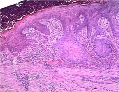 Figure 2 Lack of epidermis, infiltrate in the upper and mid dermis, which was mostly made up of leukocytes, lymphocytes, and histiocytes; absence of leukoplakia, widened vessel walls, gaping lumen, and disconnection between infiltrate and vessels (Magnification ×100).