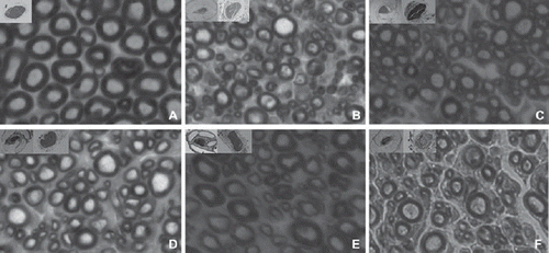 Figure 2. Images of the transverse section of the TIB nerve (stained by osmium tetroxide, X1000): the contralateral control side (A); the experimental side of the fresh-repaired group (B); the experimental side of the 1-week group (C); the experimental side of the 2-week group (D); the experimental side of the 4-week group and the experimental side of the 8-week group (E).