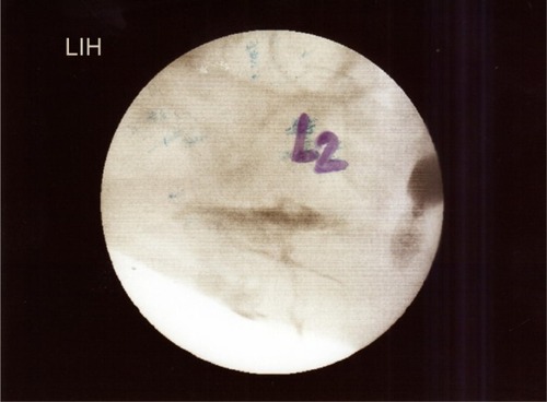 Figure 7 Radiograph in lateral projections obtained after the injection of contrast media to the paravertebral space in the presented patient (2 mL of contrast solution is seen against the posterolateral aspect of the vertebral column).