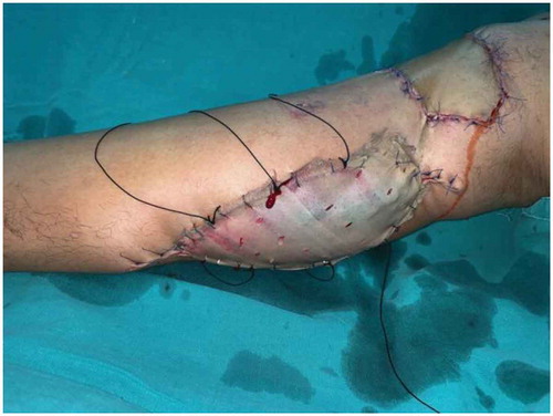 Figure 5. Skin graft of the donor site