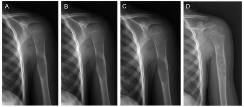 Figure 3. A representative MWA and bone grafting treatment to a mid-shaft humerus UBC.(a) A 15-year-old boy was diagnosed with a bone cyst after experiencing pain. (b) Postprocedural radiograph on the second day. (c) Postprocedural radiograph after one and a half months. (d) The postoperative humerus AP radiograph in 6 months exhibited the vast majority of UBC remineralization.