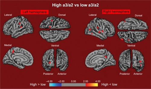 Figure 1 The red markings represent the brain regions with higher regional cortical thickness in MCI patients with high a3/a2 ratio as compared to MCI patients with low a3/a2 ratio (P<0.01 uncorrected).