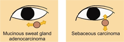 Figure 3 Scheme for the progression pattern of the sweat gland adenocarcinoma compared with sebaceous carcinoma of the eyelid. In general, a sebaceous carcinoma is vertically extended in the eyelid at the initial stage. However, the mucinous sweat gland adenocarcinoma is present on the surface of the eyelid and extends horizontally slowly onto the tarsal plate.