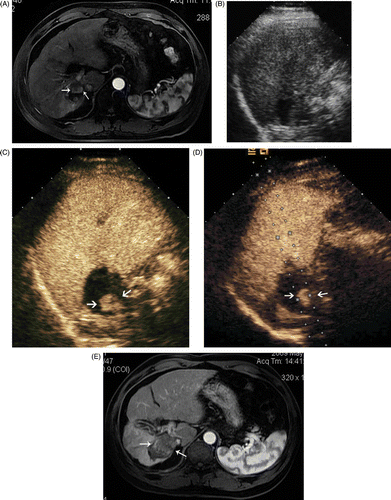 Figure 2. Images in a 52-year-old male with a 1.8 × 1.5 cm local recurrence of HCC after MW ablation in segment VII of the liver. (A) Contrast-enhanced MRI shows a local recurrence (arrows) in the right hepatic lobe. (B) Conventional US could not detect the tumour. (C) CEUS shows arterial enhancement adjacent to the ablation zone indicative of local recurrence (arrows). (D) MW antenna was inserted along the guideline under CEUS guidance (arrows). (E) Arterial phase of contrast-enhanced MRI obtained 3 months after MW ablation shows complete necrosis of the recurrence (arrows).