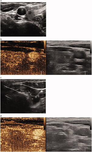 Figure 3. Pre-procedural, procedural, and post-procedural images. (a) Pre-procedural nodule localization. The solid nodule is located in the middle and upper part of the right lobe of the thyroid, with the size of 0.42 × 0.38 × 0.35 cm3. It is hypoechoic, irregular in shape, unclear in boundary, aspect ratio >1, and has no calcification. (b) Pre-procedural contrast-enhanced ultrasound (CEUS). The nodules show low enhancement. (c) Picture of the MWA process. The ablation area is shown as a bubble-like hyperecho. (d) Post-procedural CEUS. The MWA range is significantly larger than that of the tumor.