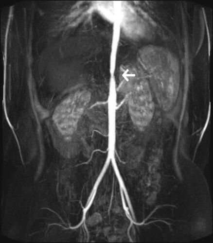 Figure 4 MR angiography showing aortic stenosis (arrow) at the thoracoabdominal transition in a 20-year-old patient with Takayasu disease.