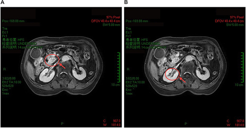 Figure 1 Gadolinium-enhanced total abdomen MRI images of an 83-year-old patient with lesions in the pancreas and renal pelvis on November 15th, 2021. The lesion located in uncinate process of head of pancreas showed gradual enhancement on T1-weighted image (A, red circle and arrow). The main pancreatic duct was widened. Lesion (MD = 2.3 cm) in the right renal pelvis showed mild, uneven enhancement (B, red circle and arrow).