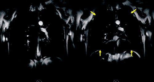 Figure 11 Coronal TrueFISP sequence with temporal resolution of 100 ms for assessment of the thoracic motion. Fast forced expiration (FEV1 manouver) starting from the maximum of inspiration (A) and ending at the maximum of expiration (B). Note the marginal difference of both images in the patient suffering from severe emphysema.