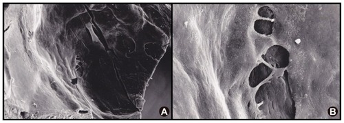 Figure 2 SEM of the optic disc pit with defects in the overlying diaphanous membrane. (A) SEM of the optic disc pit with defects in the overlying diaphanous membrane (arrows). (B) higher magnification allows visualization of the base of the optic pit through these membranous defects.