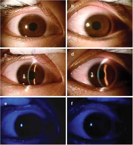 Figure 2. Slit-lamp examination photos on the thirty-second day after the second dose of COVID-19 vaccination.