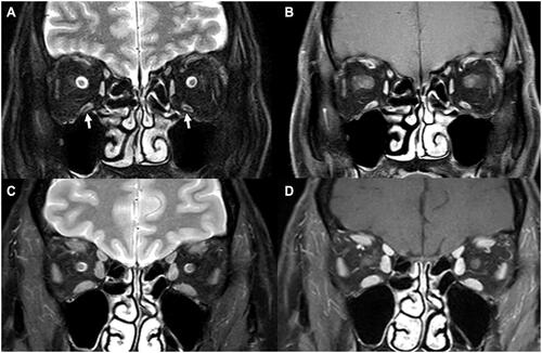 Figure 3 (A) Coronal T2-weighted orbital magnetic resonance imaging with fat suppression (T2W/FS) and (B) coronal CE-T1W/FS in a 49-year-old woman with myasthenia gravis for 10 years, showing bilateral extraocular muscle (EOM) atrophy and isointensity with central hypointensity of bilateral inferior rectus muscles (arrow); (C) Coronal T2W/FS and (D) coronal CE-T1W/FS in a control participant, showing normal EOM size and isointense muscles.