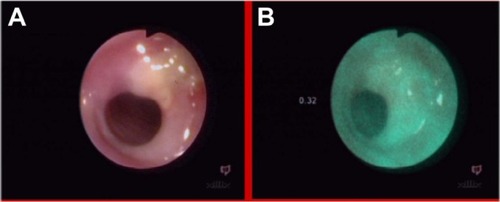 Figure 20 Esophagus of patient after nitro solvent chemical burn, in white light endoscopy (A) and autofluorescence (B) imaging.