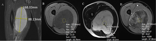 Figure 2 Illustration of how to measure quantitative indicators. (A) Tumor size was calculated based on the maximum length of the tumor. Roundness was the ratio of the maximum width to the length of the tumor (measured on the respective axis). (B–D) Illustration showing how to place the ROI of the tumor signal on axial T1W (B), T2W (C), and contrast-enhanced T1W (D).