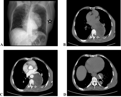 Figure 1 Scout film showing a well-defined homogenous opacity in left hilum with hilar overlay sign and indistinct descending aorta localizing the lesion in posterior mediastinum. Increased density of the left side chest wall with asymmetry is noted (white star) (A). Axial pre- and post-contrast chest CT image in the Mediastinal window at T5 level shows a large (> 10 cm), non-enhancing, low density (HU values on CT show low density (mean HU ± SD = − 1 ± 10)) cyst with lytic lesion of adjacent vertebral body and rib seen (B and C). Areas of calcification are seen in the cyst wall and superior part of the cyst (white arrow) (D).